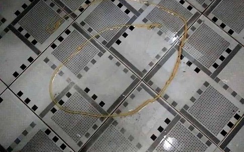 Kinh hoàng sán xơ mít dài hơn 2 mét 'chui' khỏi cơ thể người đàn ông ở Nghệ An