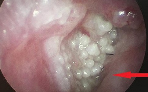 Người đàn ông bị sùi mào gà vì thường xuyên đi lấy ráy tai: Cảnh báo những thói quen tai hại dễ rước bệnh vào người