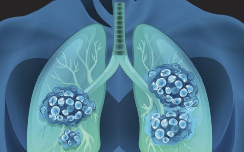 Sản phẩm Tumolung – Bước đột phá mới trong việc phòng ngừa và hỗ trợ điều trị u phổi