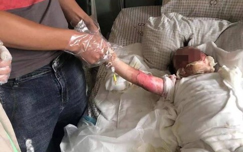 Bé 2 tuổi ngã vào chảo dầu sôi, hành động tưởng cứu nguy của cha mẹ hóa ra hại con