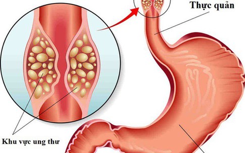 "Ngất xỉu" khi nghe BS báo tin bị mắc 2 bệnh ung thư cùng lúc: Ân hận vì 3 thói quen xấu