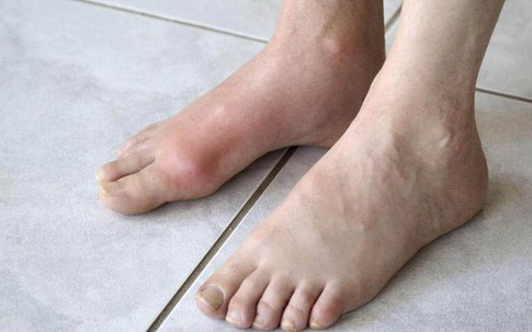 Cậu bé 13 tuổi mắc bệnh gout, nguyên nhân đến từ thức uống mà hầu hết đứa trẻ nào cũng ưa thích