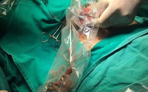 Từ vụ mổ cấp cứu lấy búi giun 100 con trong bụng bệnh nhân 11 tuổi, cha mẹ cần làm ngay những việc này kẻo sau lại hối tiếc
