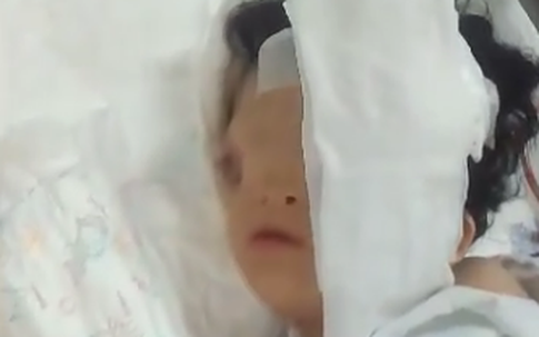 Bé gái có khuôn mặt biến dạng được đoàn bác sĩ Anh phẫu thuật miễn phí ở Hà Nội