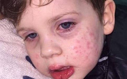 Bé trai 3 tuổi nhiễm virus bệnh tình dục sau nụ hôn vào má