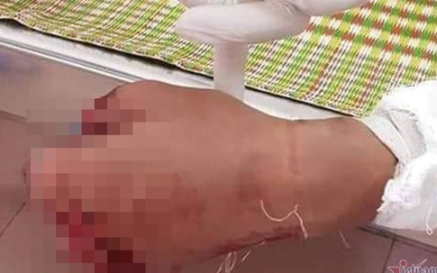 Thanh niên Quảng Trị nát bàn tay vì dùng điện thoại khi đang sạc