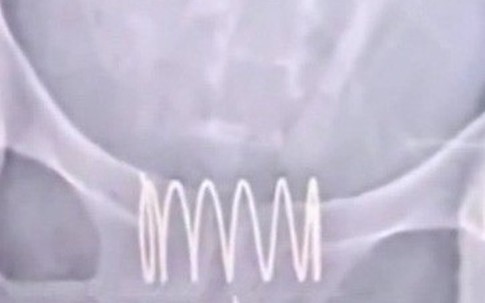 Nữ bệnh nhân cho lò xo vào "phần dưới" suốt nửa năm, bác sĩ bất ngờ khi biết lý do