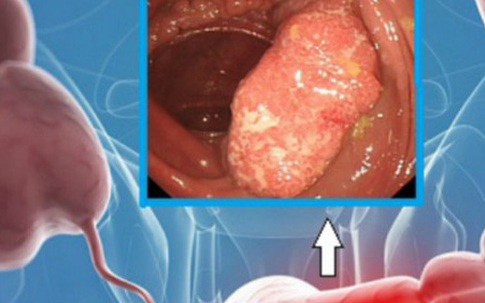 Rối loạn tiêu hóa, đi ngoài phân lỏng - phát hiện ung thư
