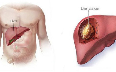 Dưỡng gan đúng hay sai đều bắt đầu từ việc ăn uống, đây là 4 việc bác sĩ rất tán thành