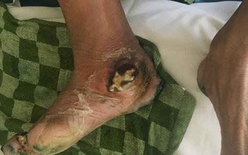 Cắt bỏ phần bàn chân hoại tử vì xơ vữa động mạch