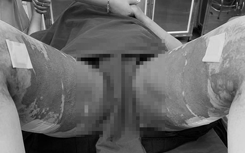 Đôi chân biến dạng của cô gái 28 tuổi sau hút mỡ tại thẩm mỹ viện