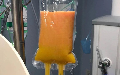 Ăn gà rán, 2 ngày sau sản phụ bị đau bụng, bác sĩ phải lọc huyết tương để cứu, các tạp chất lọc ra vàng như mỡ