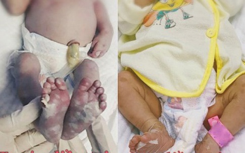 Cứu bé sơ sinh mắc bệnh giang mai bẩm sinh