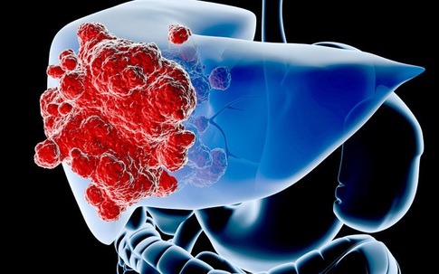 Căn bệnh nhiều người mắc mà không biết, ai ngờ có thể âm thầm tiến triển thành ung thư gan