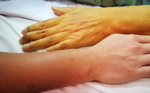 Lo lắng vì bỗng nhiên bị u gan, ai ngờ mắc loại bệnh "khó nói" từ món ăn triệu người Việt ưa thích