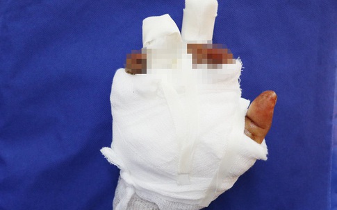 Người phụ nữ bị dập nát bàn tay khi thu gom sắt vụn