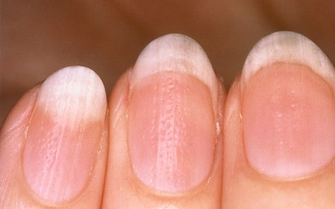 9 dấu hiệu cảnh báo bệnh tật trên móng tay: Dấu hiệu bệnh về gan rất dễ nhận biết