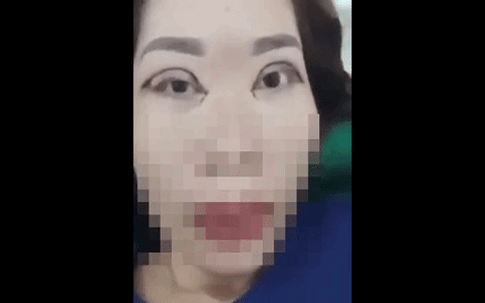Đôi mắt "gây ám ảnh" bậc nhất hôm nay là trường hợp cắt mí lỗi đến mức không thể khép mắt này: BS khuyến cáo những thông tin cần nhớ trước khi làm