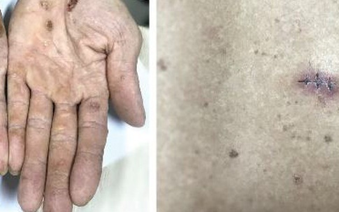 Cảnh báo nhiễm độc thạch tín gây ung thư da mà không hề hay biết
