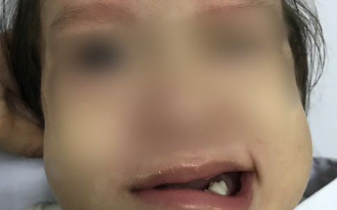 Bé gái 17 tháng tuổi đột ngột liệt mặt sau khi chảy mũi, ngạt mũi