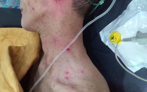 Hai cha con bị ong đốt phải nhập viện cấp cứu