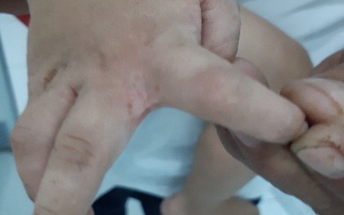 Ký sinh trùng lúc nhúc dưới lớp da tổn thương của bệnh nhi