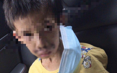 Bé trai 7 tuổi tàn phế vì bị bạo hành: Bố đâm tàn thuốc khắp người, mẹ dùng dao khứa vào chân, hình ảnh nạn nhân gây đau lòng