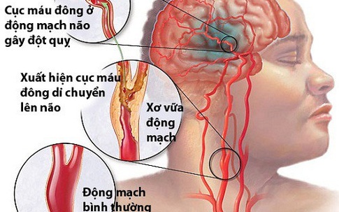 4 sai lầm khi xử lý người bị đột quỵ nhiều người mắc phải để lại hậu quả đáng tiếc