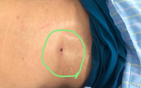 Người đàn ông suy đa tạng sau khi bị mò đốt