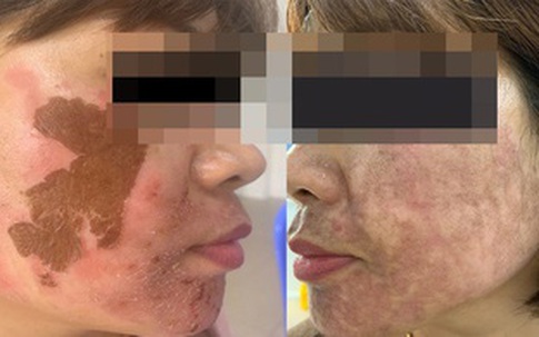 Người phụ nữ bị tai biến vì trị nám ở spa