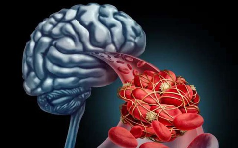 Nhồi máu não đến quá nhanh, nhận biết được 5 triệu chứng bạn sẽ tự cứu sống mình