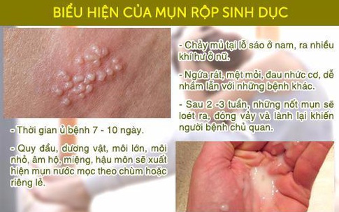 Mụn rộp sinh dục