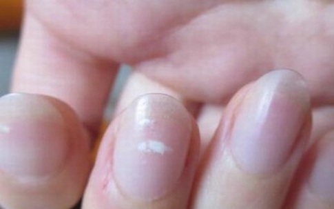 4 dấu hiệu lạ trên tay có thể là dấu hiệu cảnh báo thận của bạn có thể đang suy yếu, cần theo dõi thêm để bảo vệ sức khỏe