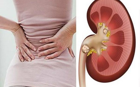 Chuyên gia chỉ rõ 6 thói quen xấu gây sỏi thận người Việt hay mắc phải