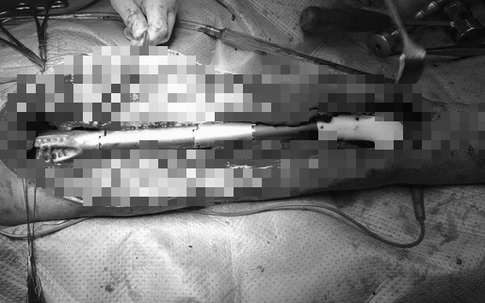 Kỳ tích: Người đầu tiên ở Việt Nam đi được nhờ xương đùi... kim loại