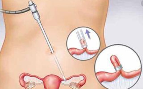 Nga Phụ Khang – Chìa khóa “vàng” giúp cải thiện u xơ tử cung, u nang buồng trứng