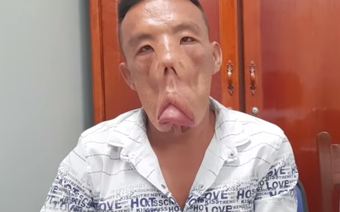Chuyện người đàn ông mang "khuôn mặt quỷ" đến Sài Gòn tìm lại khuôn mặt người