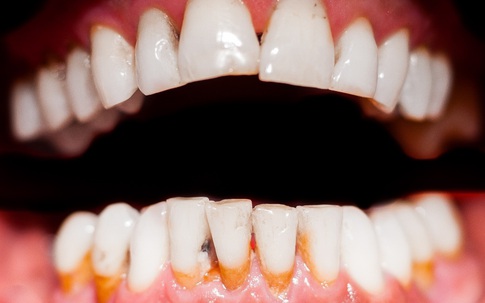 Những bệnh lý răng miệng có thể gây mất răng vĩnh viễn
