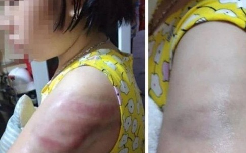 Tường trình của cô giáo đánh học trò bầm tím tay do viết bài chậm ở Nam Định