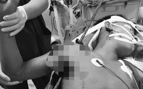 Tránh viên gạch rơi vào đầu, thanh niên 19 tuổi ở Hà Nội bị thanh sắt đâm thủng vai