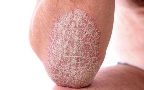 Kim Miễn Khang & Explaq: Giải pháp cho người mắc vảy nến thể mảng