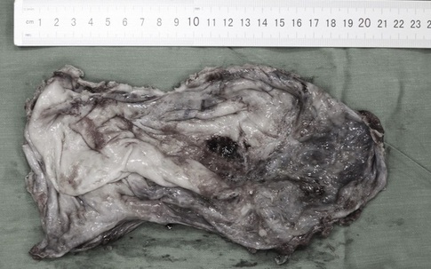 Mổ cắt u nang buồng trứng cùng 2,5 lít dịch cho cô gái 21 tuổi