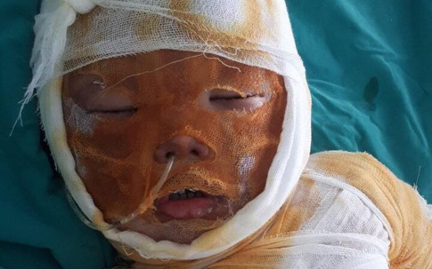 Xót xa bé trai 4 tuổi bị bỏng nặng cần tiền hỗ trợ để cấy ghép da
