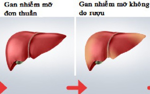 Bé trai mới 8 tuổi đã phát hiện bị gan nhiễm mỡ