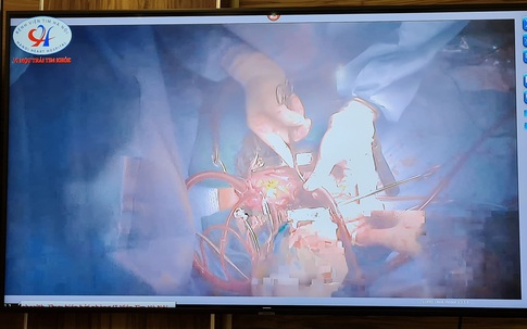 VIDEO: Bệnh viện Tim Hà Nội vừa tư vấn cho bệnh nhân nhồi máu cơ tim vừa chỉ đạo mổ từ xa