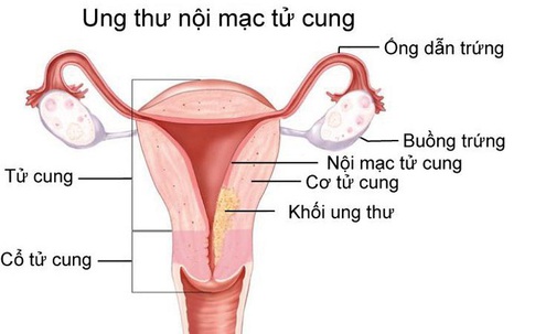 Niêm mạc tử cung dày bất thường không điều trị, 3 năm sau bị ung thư nội mạc tử cung