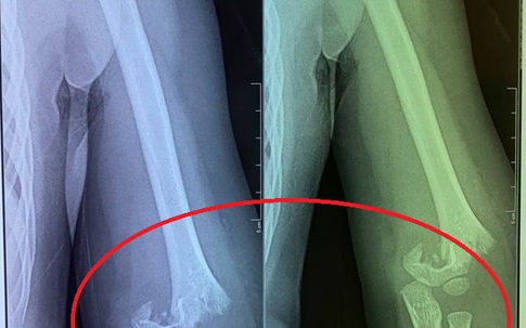 Hà Nội yêu cầu xác minh vụ trẻ mầm non bị ngã gãy tay tại trường