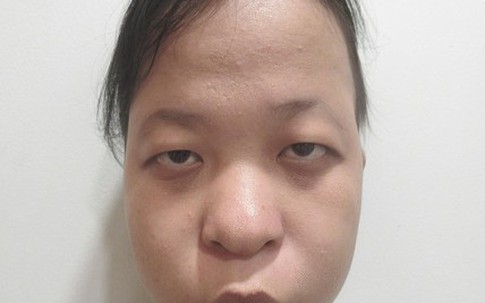 Nước mắt hạnh phúc của cô gái sau 19 năm hói đầu bẩm sinh