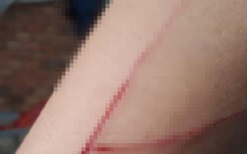 Thông tin bất ngờ liên quan vết rạch trên tay bé gái 15 tuổi bị hiếp dâm