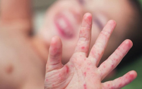 Sốt cao không hạ: BS Bệnh viện Nhi khuyến cáo có thể là dấu hiệu tay-chân-miệng nặng